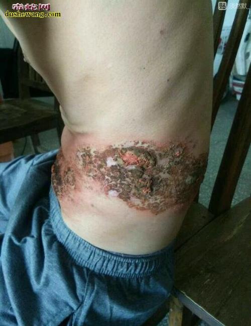 蛇胆疱疹图片身上长蛇胆疮是什么样子的