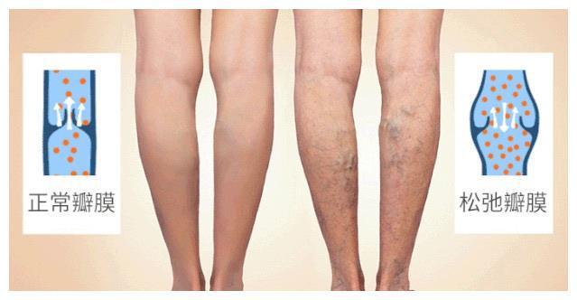 早期小腿静脉曲张图片小腿静脉曲张早期症状