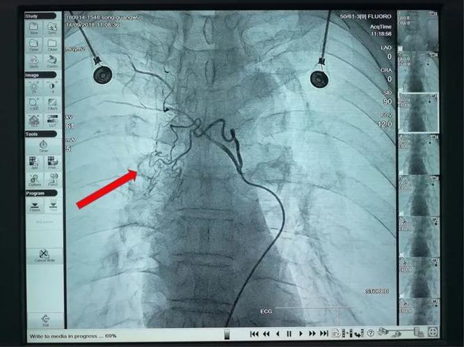 第504期肺癌患者经过三次支气管动脉化疗栓塞后肿瘤几近消失建华医院