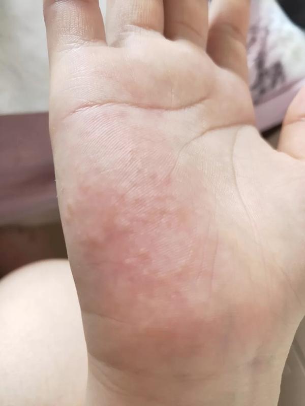 25岁女孩手痒起水泡,越挠越痒,医生:出现这种不适,建议早应对