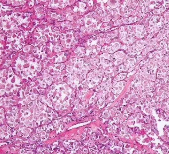 腺泡状软组织肉瘤恶性程度不高,肿瘤生长较为缓慢.