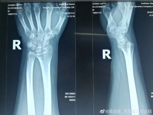 右桡骨远端骨折 下尺桡关节脱位