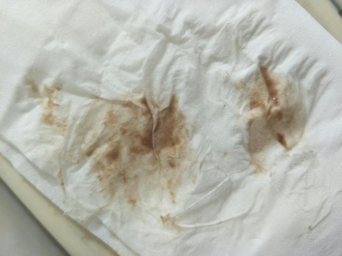 孕初期有褐色分泌物,还腰痛