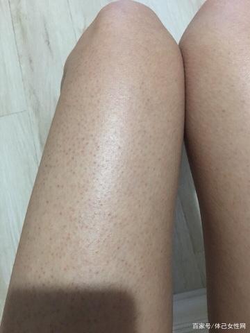 鸡皮肤难看不敢穿短裙?别怕,用好这三招大胆秀美腿