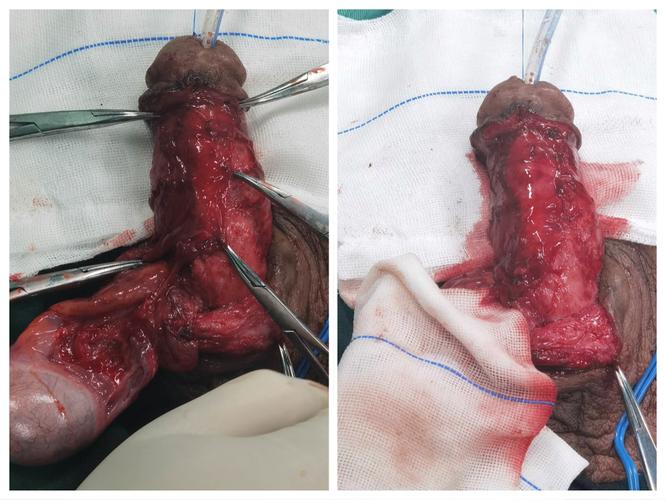 张家界市人民医院成功完成一例复杂性尿道狭窄修复手术.