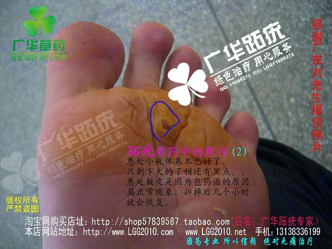脚底很多水泡老茧鸡眼胼胝连宗瘊刺瘊甲周瘊镶嵌疣粉瘊子骨刺疣血刺泡