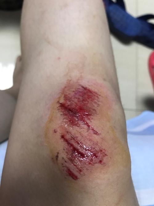 膝盖摔伤,抹了碘伏结痂后如何防止留疤?