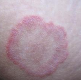 什么是铜钱癣?摸清病情根治快