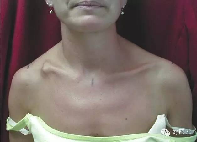 非手术性治疗后的症状性锁骨畸形愈合发生率 手术修复后的骨不连发生