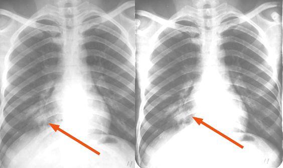 x 线表现(三大特征):肺部弥漫性病变,两肺出现多发小片状或大片状密度
