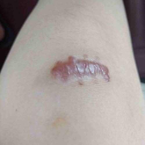 膝盖缝针可以泡水吗?