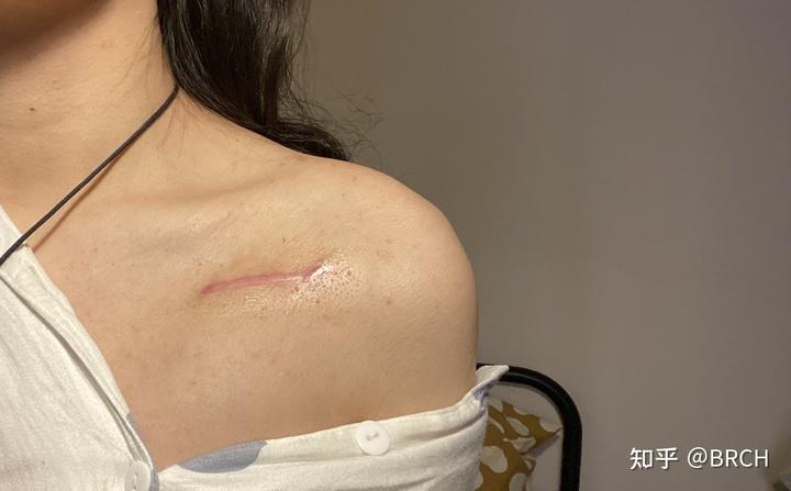 22岁伊始,跟心脏起搏器打个招呼——我与起搏器全纪录