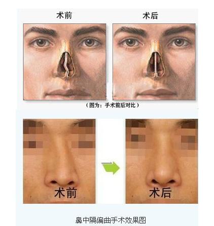 鼻中隔偏曲的治疗