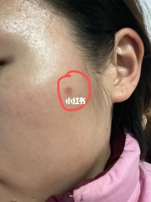 点完痣要如何保养