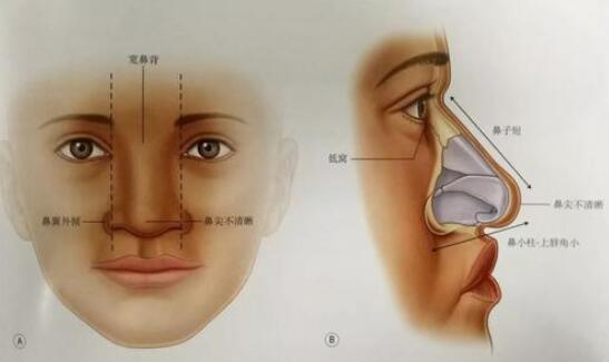 鼻骨缩小效果好不好