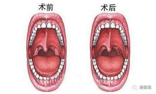 扁桃体 大部分人过了30岁后扁桃体就萎缩了.