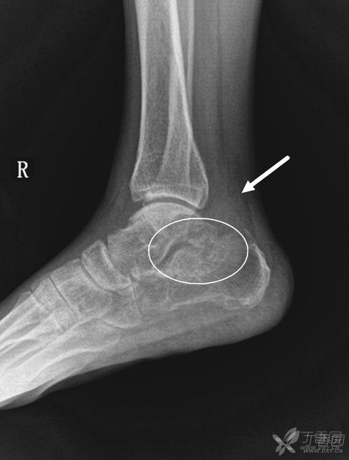 急救与危重病讨论版 急诊影像学(x片,ct,超声等.)