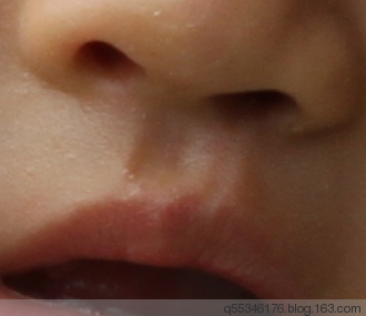 隐性唇裂临床表现 - 包冰医生 - 包冰医生