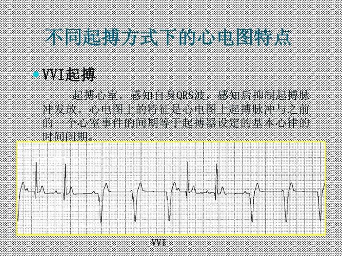 的一个心室事件的间期等于起搏器设定的基本心律的 时间间期 时间间期