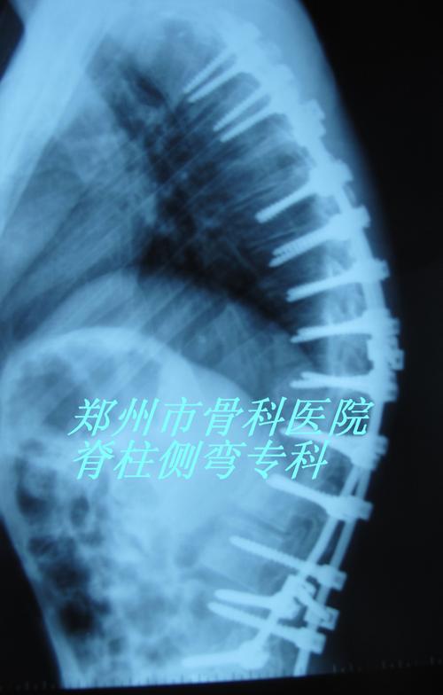 严重脊柱后凸获矫正--多节段smith-petersen截骨技术