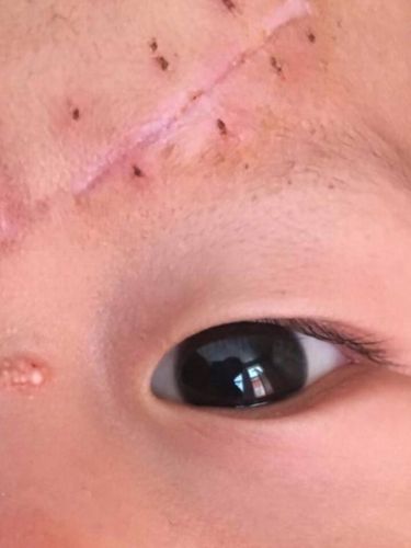 宝宝一岁七个月的记录_疤痕_小朋友_药膏_眉毛_母婴