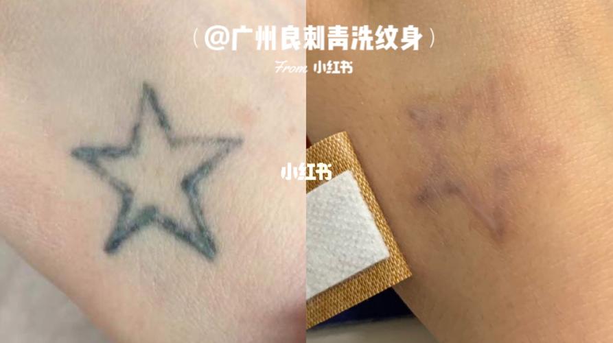 洗毁后修复凸起增生_纹身_疤痕_广州洗纹身_美妆_医美