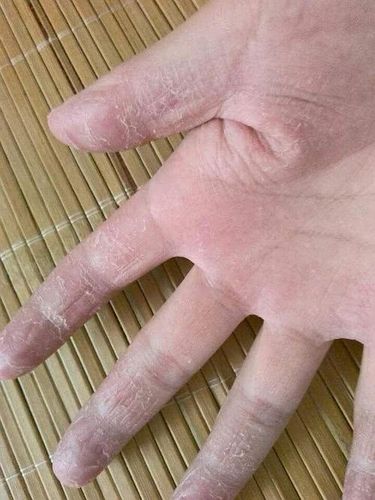 糖尿病患者病情加重以后,手上会有这3种异常表现?你注意到了吗