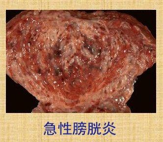 答:你好,女性膀胱炎有哪些症状?急性膀胱炎:急性膀胱炎症状有