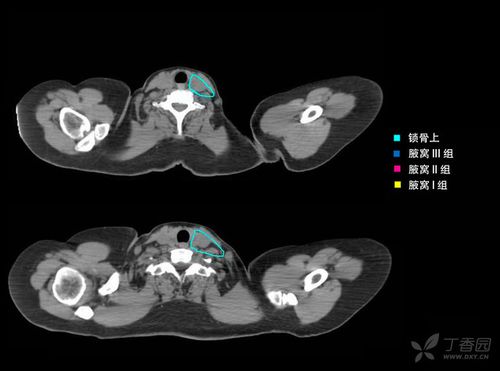 快速掌握:乳腺癌锁骨上淋巴结引流区勾画