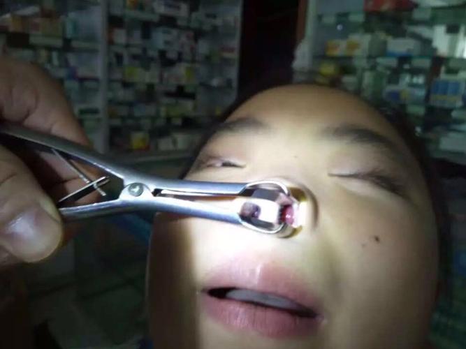 儿童鼻甲肥大常见的几个病因是什么?