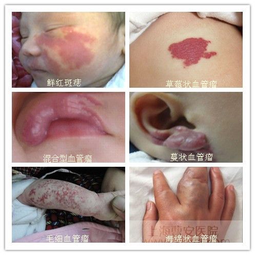 唇部血管瘤的疾病类型