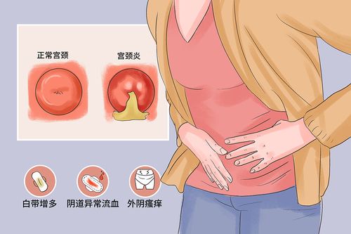 慢性宫颈炎