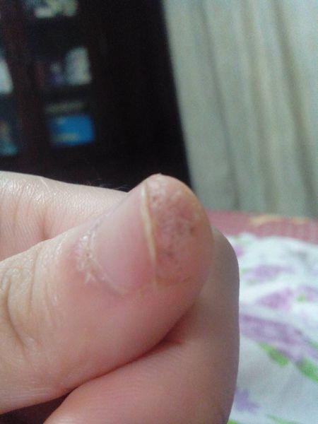 我指甲上面有块皮肤变硬 像老茧一样 皮肤下面还有一粒粒像出血点一样