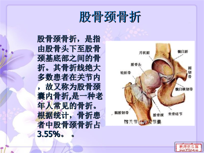 股骨颈骨折幻灯幻灯片.ppt