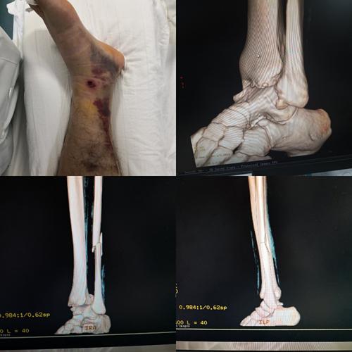 踝关节骨折