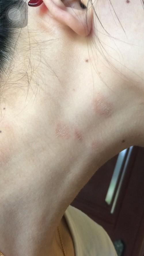 最近脖子上一块块红,有时痒,红的地方皮肤发皱.请问这是什么病,严