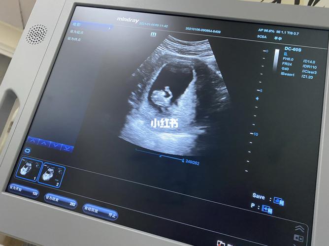 孕十一周整的小宝宝_孕期_长腿_正能量_建档_孕期日常