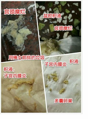 用棒女郎后的排出物对比图