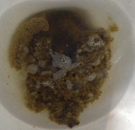 真心恳求消化科医生帮忙,差不多快一年了,拉的大便,形状怪异.