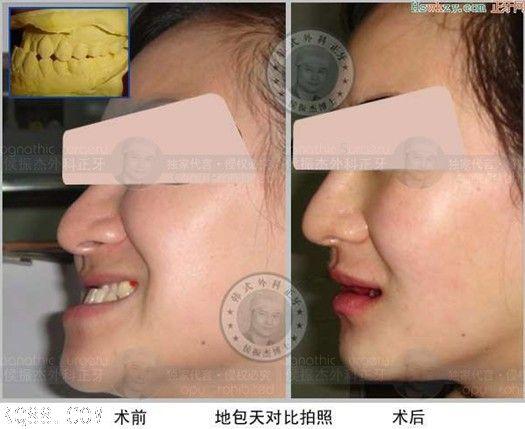 下颌骨前突突下巴矫正案例