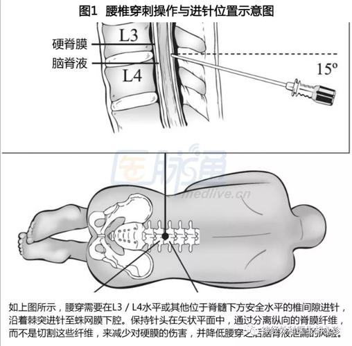 腰椎穿刺术,我们为什么要做?