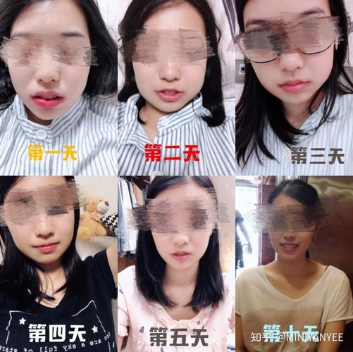 住院局麻一次性拔四颗智齿是什么体验