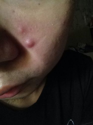 鼻子旁边长了两颗很大的痘痘,还怎么办?