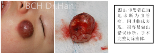 儿童钙化上皮瘤(毛母质瘤)手术时机及治疗方案的选择