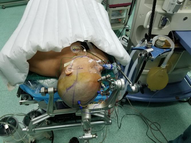 改良kawase入路切除岩斜区脑膜瘤