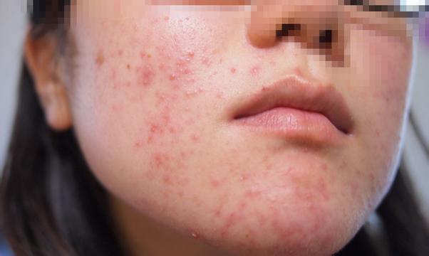 脂溢性皮炎又称脂溢性湿疹,是发生在皮脂腺丰富部位的一种慢性丘疹