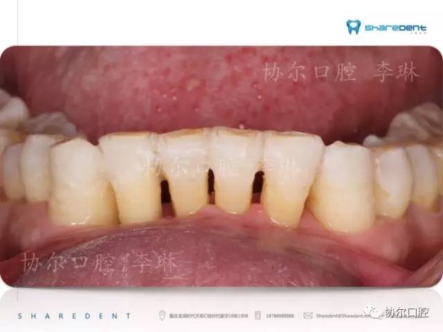 牙邻接区涂布牙科材料,将松动牙与健康邻牙连接成整体,形成牙周夹板