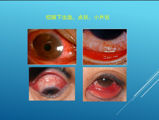 流行性角结膜炎(ekc)的表现和治疗