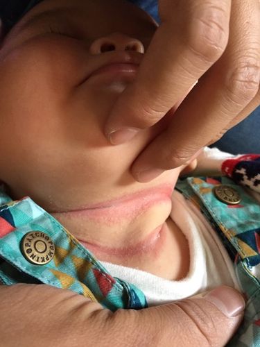 宝宝脖子红,有什么办法吗?人家说粉不能擦了,擦山茶油才好,对吗?