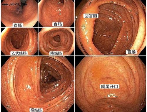 图三:正常肠镜下各部位结肠形态 2.做肠镜有哪些目的,我能不能不做?